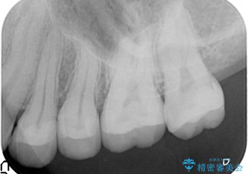 3本仮づめのまま放置 セラミックインレーへの治療後