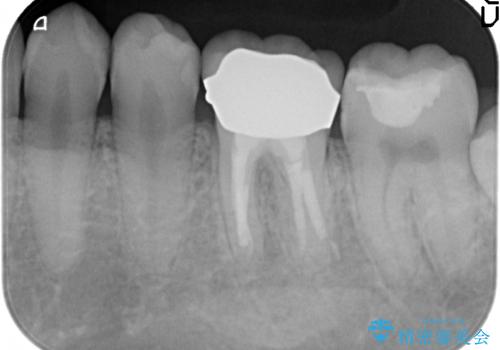 放置してしまった歯 根管治療からの機能回復の治療後