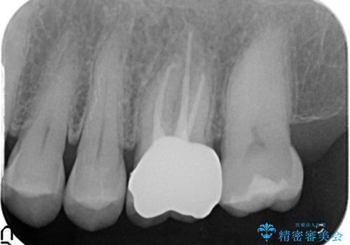 オールセラミッククラウン 精密根管治療~神経が死んでしまった歯の治療~の治療後