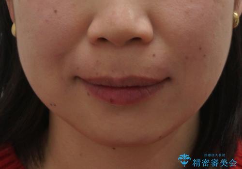 口ゴボでお悩みの方必見! 不自然なセラミックをやり直す矯正 セラミックだけでは、口元は下がりません。の治療後