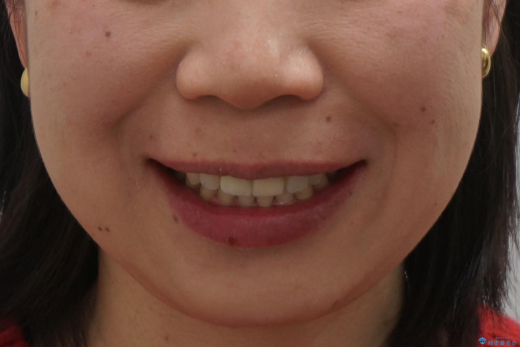 口ゴボでお悩みの方必見! 不自然なセラミックをやり直す矯正 セラミックだけでは、口元は下がりません。の治療後(顔貌)