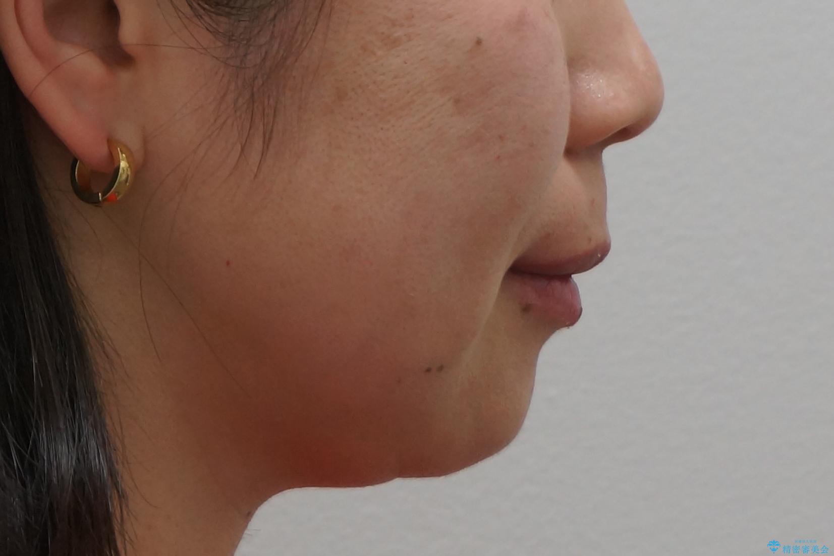 口ゴボでお悩みの方必見! 不自然なセラミックをやり直す矯正 セラミックだけでは、口元は下がりません。の治療後(顔貌)