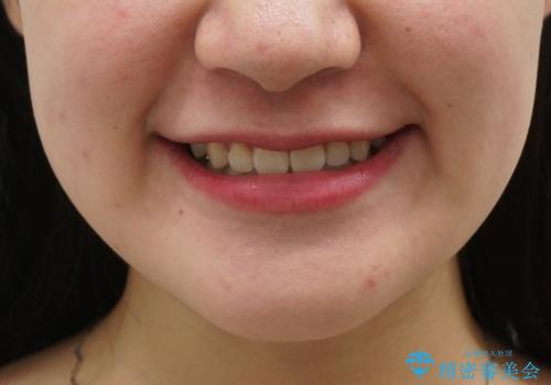 受け口 親知らずを取り込む矯正治療の症例 治療後