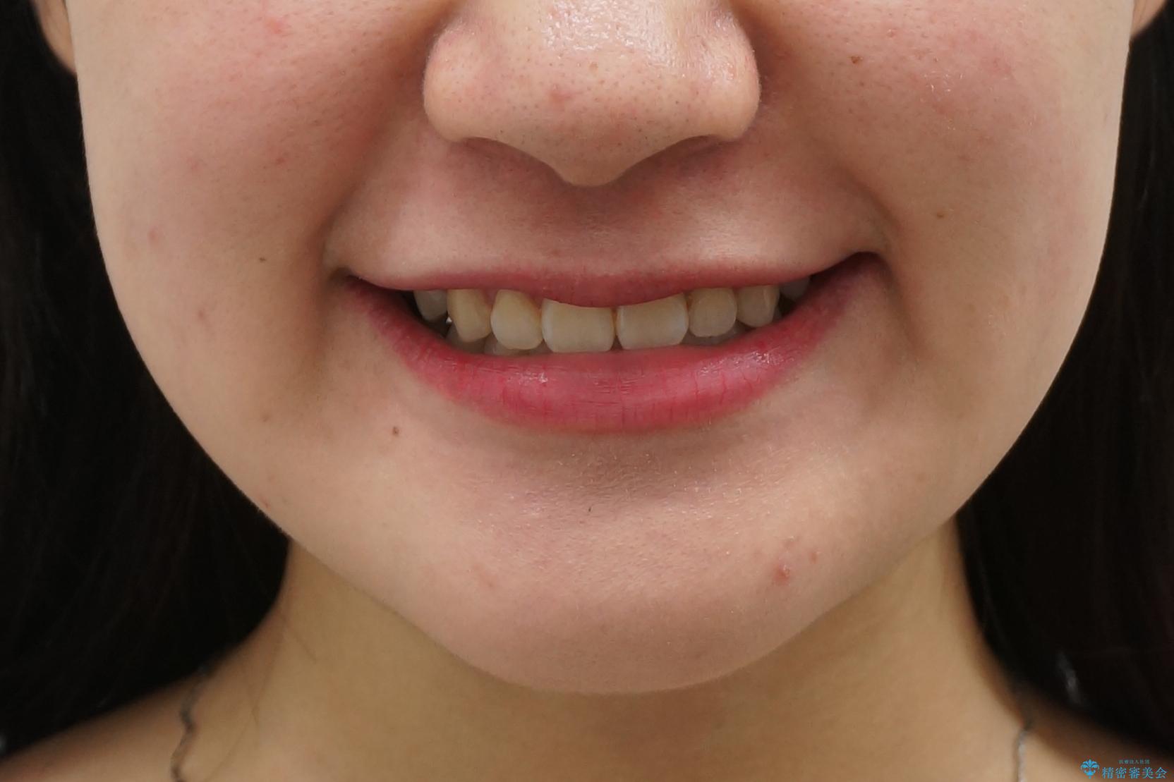 受け口 親知らずを取り込む矯正治療の治療後(顔貌)