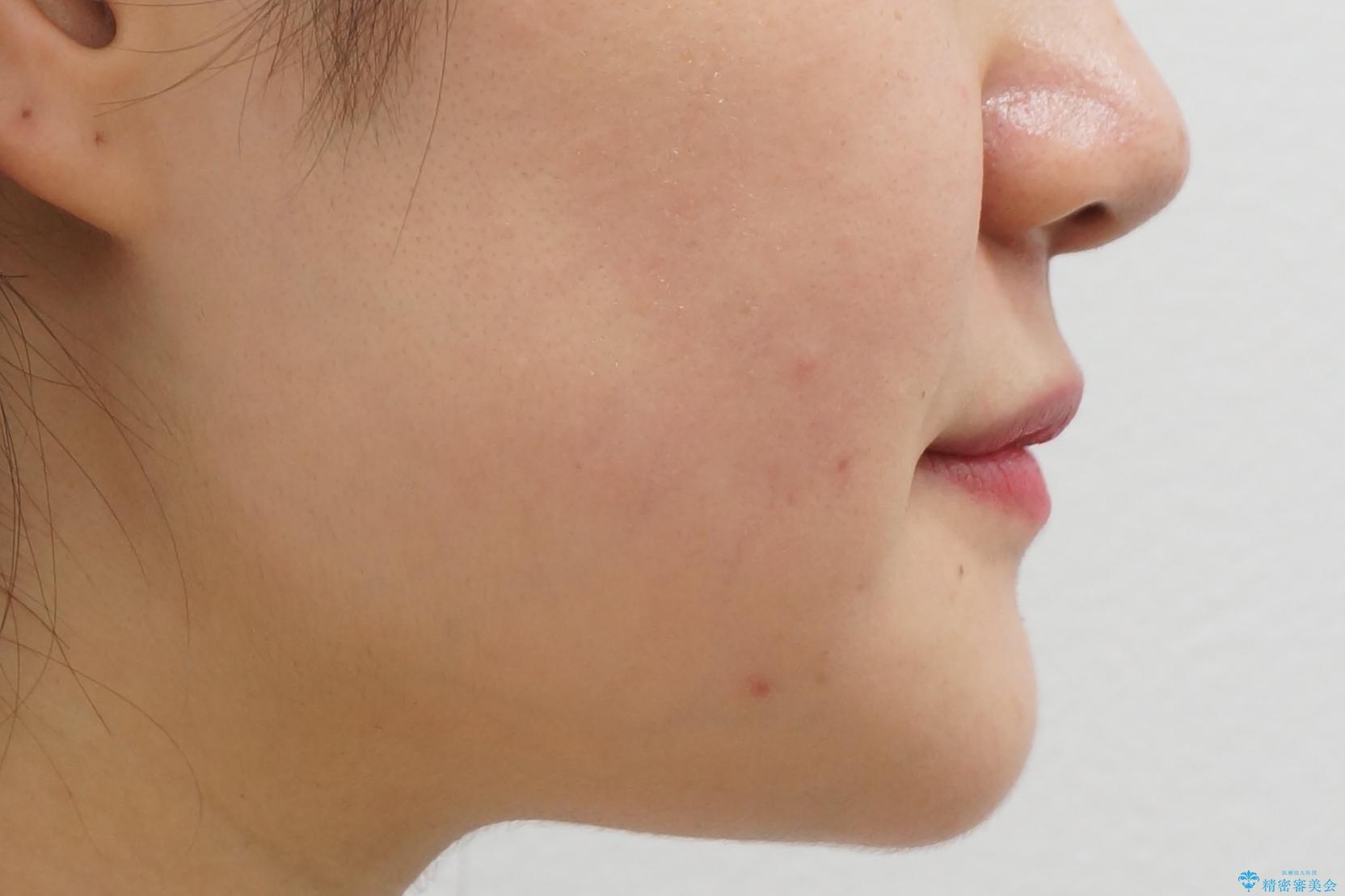 受け口 親知らずを取り込む矯正治療の治療後(顔貌)