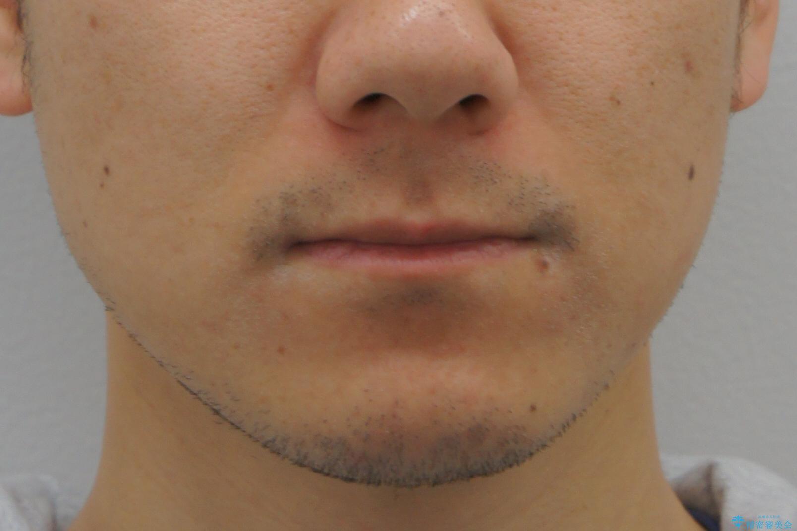 受け口 マウスピースで矯正治療 難易度:中の治療前(顔貌)