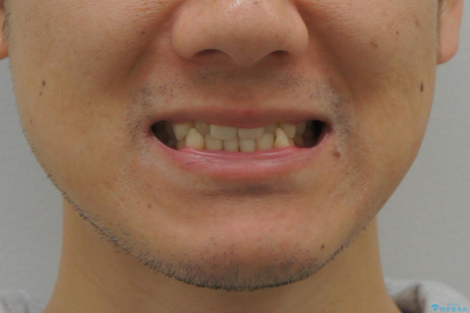 受け口 マウスピースで矯正治療 難易度:中の治療前(顔貌)