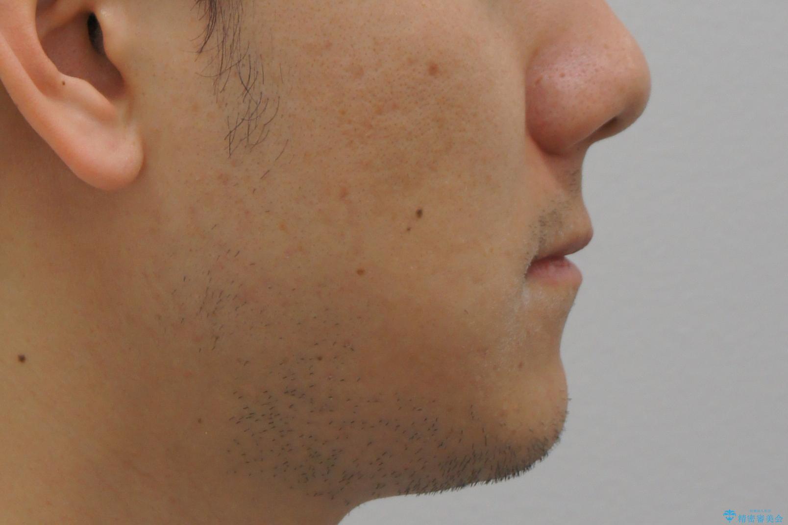 受け口 マウスピースで矯正治療 難易度:中の治療前(顔貌)