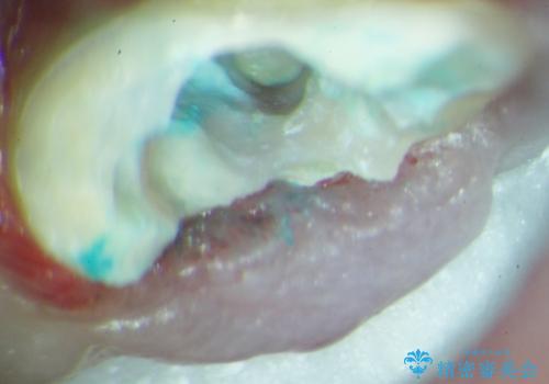 歯が折れた どうしても抜きたくない 歯の牽引で保存可能にの治療中