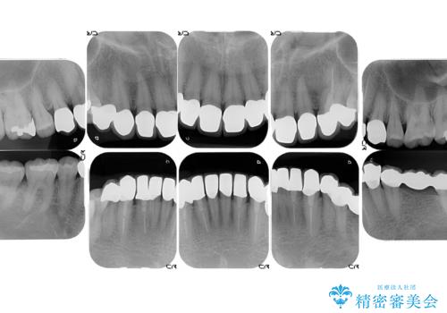 オールセラミッククラウン・セラミックインレー 口腔内全体の見た目の改善の治療後