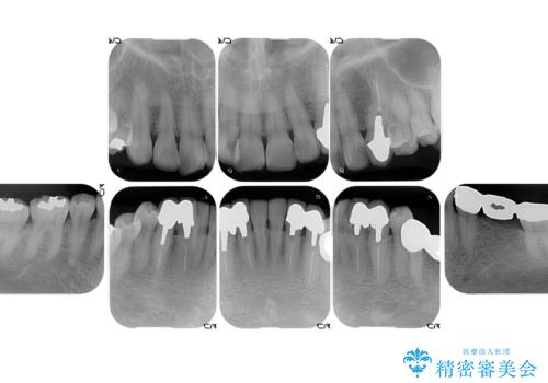 オールセラミッククラウン・セラミックインレー 口腔内全体の見た目の改善の治療前