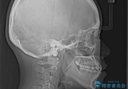 ハーフリンガル 反対咬合の改善の治療前