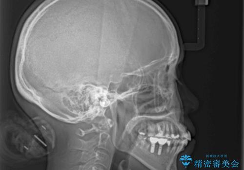 この際全てをしっかりと治療したい 総合歯科治療の治療中