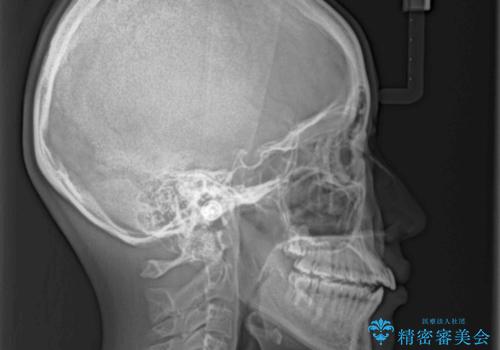 オープンバイトのインビザラインを用いた再矯正 の治療前