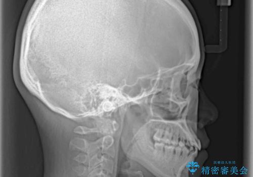 ハーフリンガル 反対咬合の改善の治療後