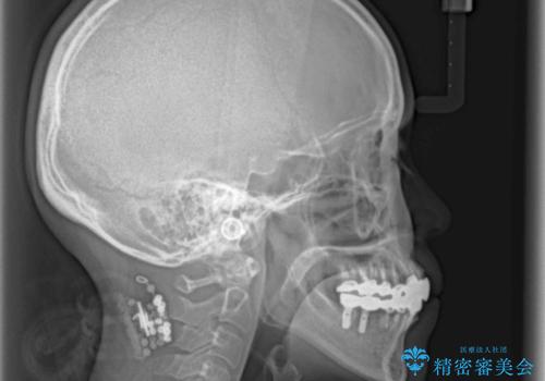 この際全てをしっかりと治療したい 総合歯科治療の治療後
