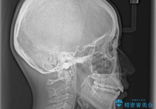 オープンバイトのインビザラインを用いた再矯正 の治療後