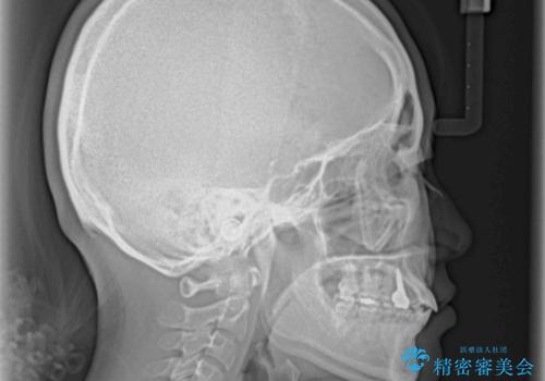 矯正治療とインプラント治療を同時に 総合歯科診療の治療後