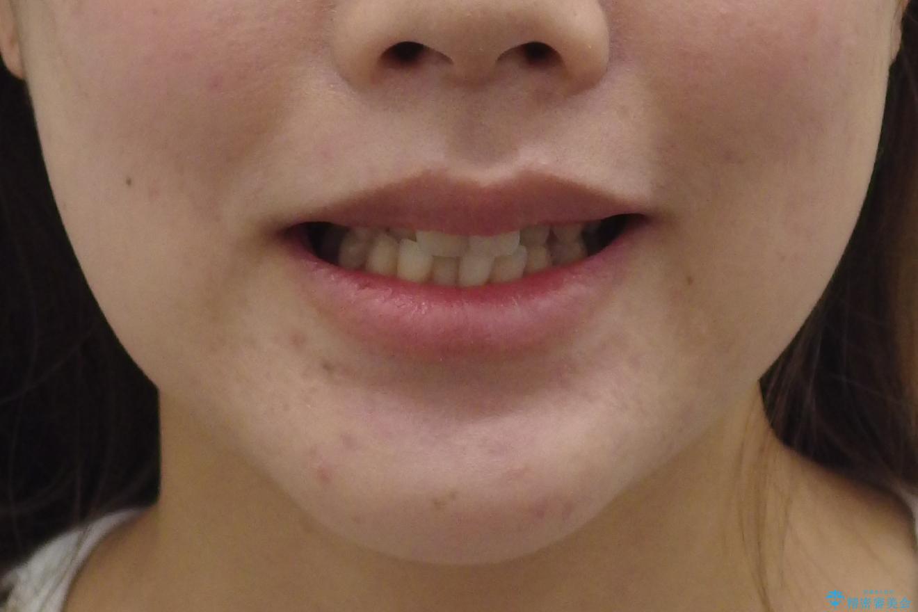 上の前歯が一部引っ込んでいる　下のがたがた　マウスピース矯正の治療前（顔貌）