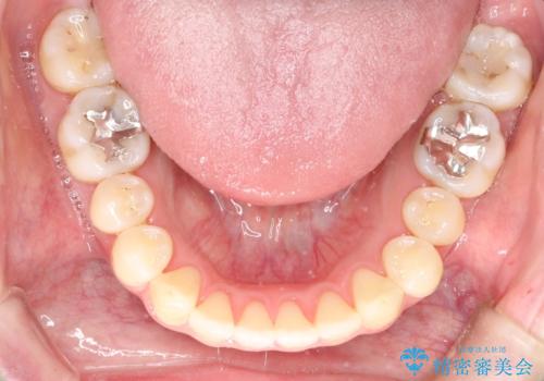 前歯でものが噛み切れない　インビザラインによるオープンバイトの治療の治療後