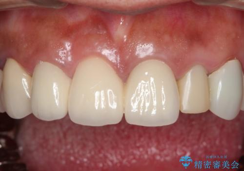 汚れてしまった前歯の仮歯 オールセラミッククラウンにて自然にの症例 治療前