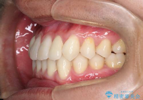 前歯のガタガタの矯正 下顎の前歯を1本抜歯してのインビザライン矯正の治療後