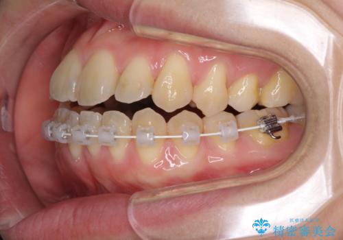 ハーフリンガル 反対咬合の改善の治療中