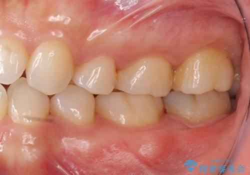 他院で次に虫歯になったら治せないと言われた 歯周外科手術でしっかり治療(APF)の治療前