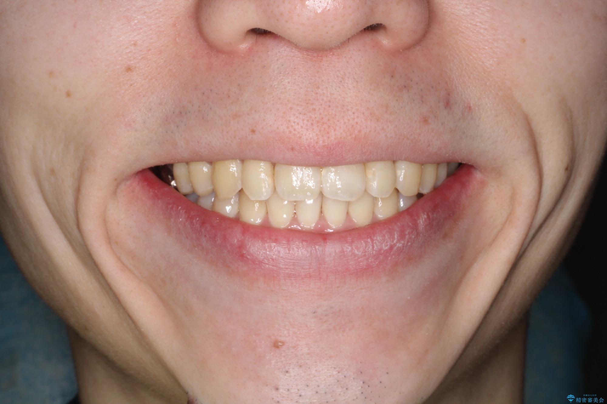 前歯でものが噛み切れない　インビザラインによるオープンバイトの治療の治療後（顔貌）