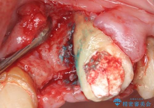 歯が折れた どうしても抜きたくない 歯の牽引で保存可能にの治療中