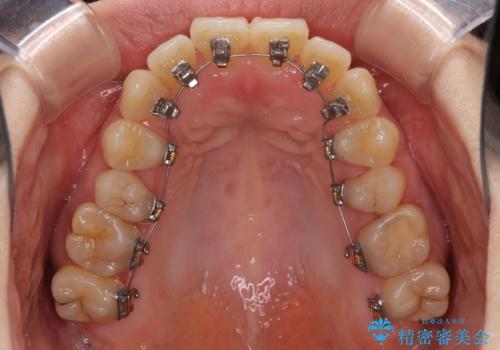 ハーフリンガル 反対咬合の改善の治療中