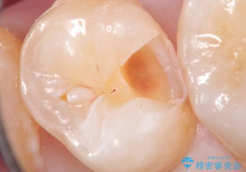 虫歯の治療。ゴールドインレーによる治療