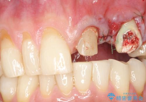 歯が折れた どうしても抜きたくない 歯の牽引で保存可能にの治療中