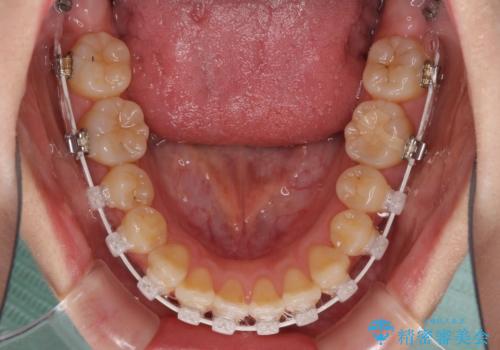 ハーフリンガル 反対咬合の改善の治療中