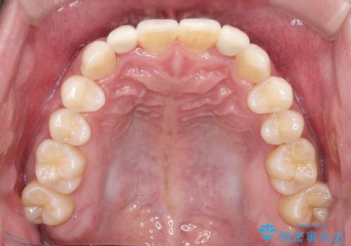 前歯のガタガタの矯正 下顎の前歯を1本抜歯してのインビザライン矯正の治療後