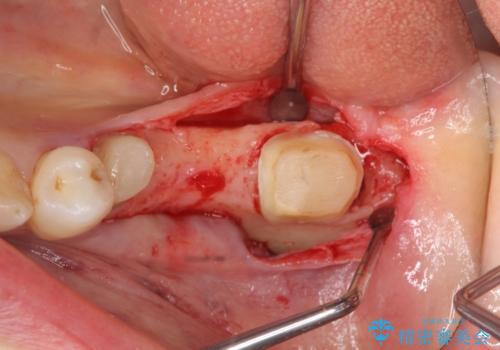 オールセラミッククラウン 欠損補綴と再生療法による深いポケットの改善の治療中