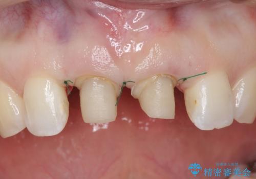口ゴボでお悩みの方必見! 不自然なセラミックをやり直す矯正 セラミックだけでは、口元は下がりません。の治療中