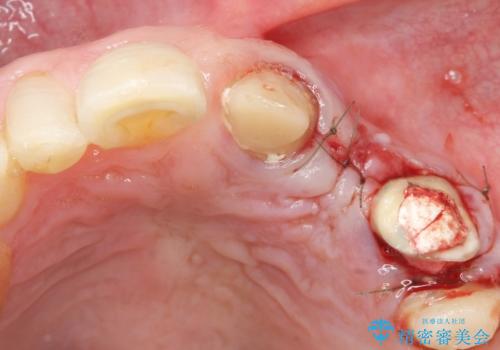 歯が折れた　どうしても抜きたくない　歯の牽引で保存可能にの治療中