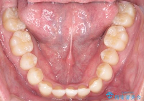 前歯のガタガタの矯正　下顎の前歯を1本抜歯してのインビザライン矯正の治療後