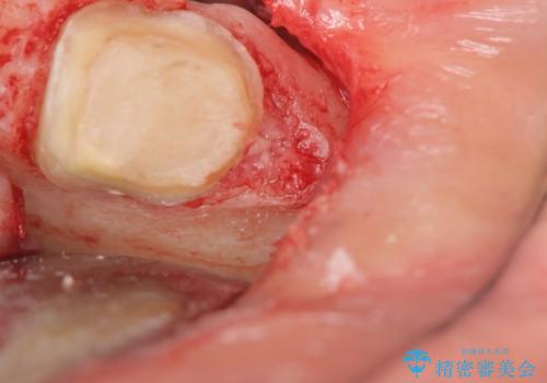 オールセラミッククラウン 欠損補綴と再生療法による深いポケットの改善の治療中