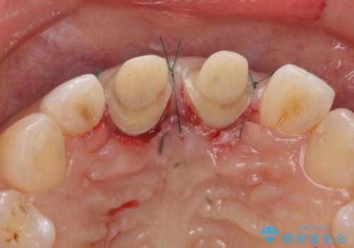 口ゴボでお悩みの方必見! 不自然なセラミックをやり直す矯正 セラミックだけでは、口元は下がりません。の治療中