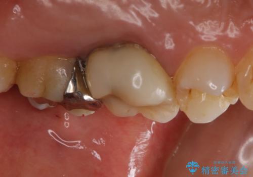 痛みの続いた歯を原因から治療の治療前