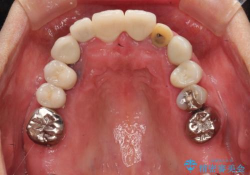 汚れてしまった前歯の仮歯 オールセラミッククラウンにて自然にの治療前