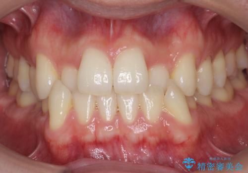 受け口 マウスピースで矯正治療 難易度:中