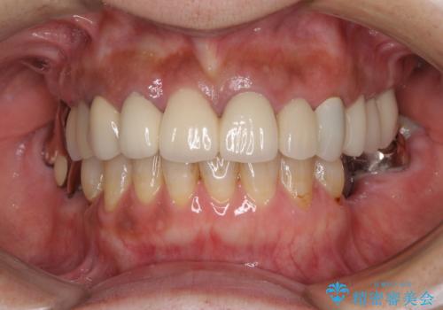 汚れてしまった前歯の仮歯 オールセラミッククラウンにて自然にの治療後