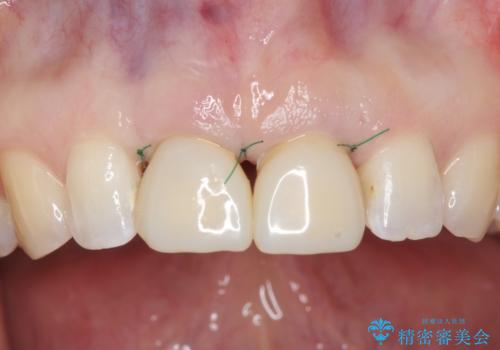 口ゴボでお悩みの方必見! 不自然なセラミックをやり直す矯正 セラミックだけでは、口元は下がりません。の治療中