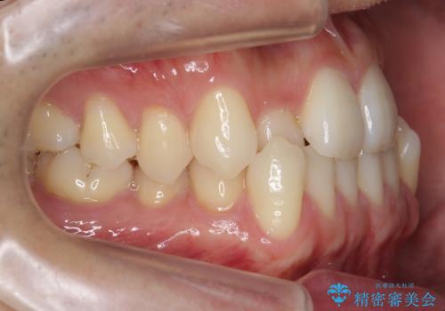 受け口 マウスピースで矯正治療 難易度:中の治療前