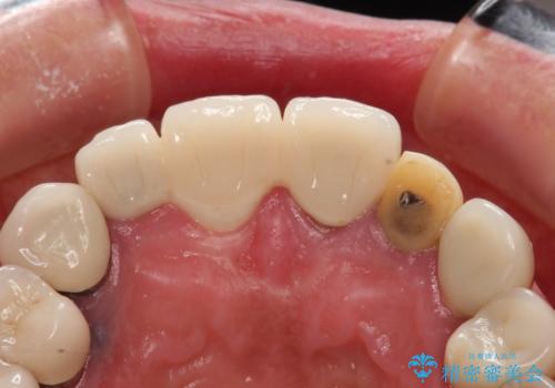 汚れてしまった前歯の仮歯 オールセラミッククラウンにて自然にの治療前