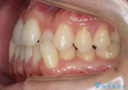 受け口 マウスピースで矯正治療 難易度:中の治療前