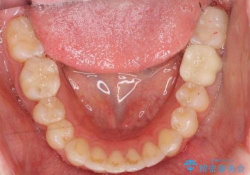 セラミックインレー　下の一番奥歯　歯ぐきの厚みを減らしてぴったりに入れます(ディスタルウェッジ+骨外科)の治療後